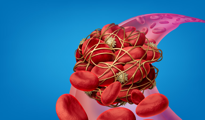 Thrombophilia Profile