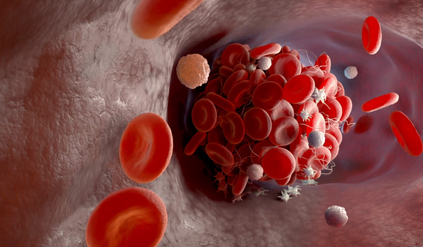 Antiphospholipid profile (APS-complete)